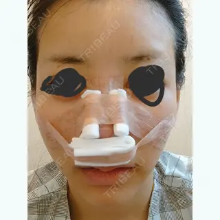 0日目の経過画像（1枚目）