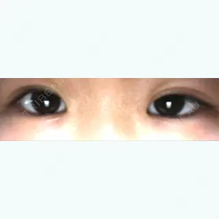 15日目の経過画像（1枚目）