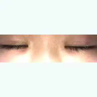 15日目の経過画像（3枚目）