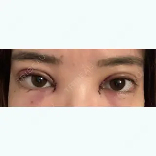 1日目の経過画像（1枚目）