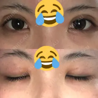 15日目の経過画像（1枚目）