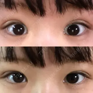 28日目の経過画像（1枚目）