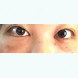 2日目の経過画像（1枚目）