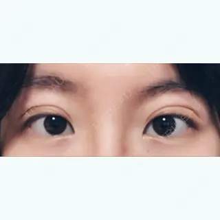 4日目の経過画像（1枚目）
