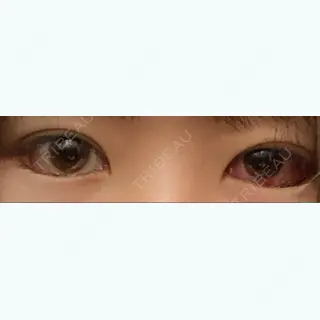 3日目の経過画像（1枚目）