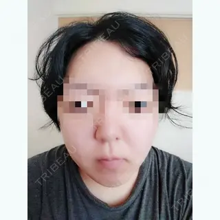 4日目の経過画像（1枚目）