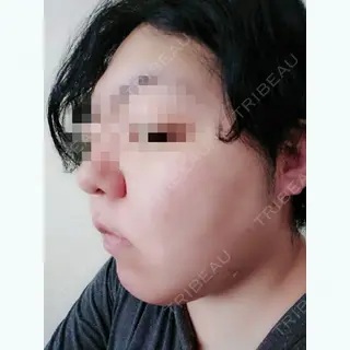 5日目の経過画像（2枚目）