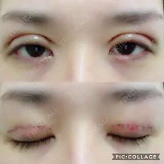 6日目の経過画像（1枚目）