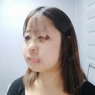 4日目の経過画像（2枚目）