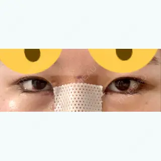 5日目の経過画像（1枚目）