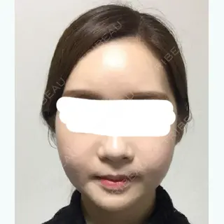 35日目の経過画像（1枚目）