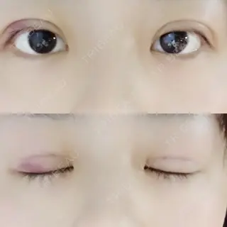 2日目の経過画像（1枚目）