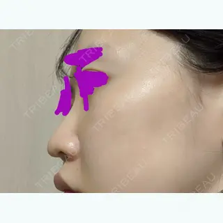 11日目の経過画像（2枚目）