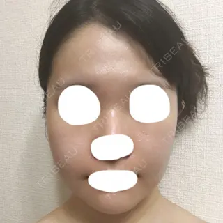 31日目の経過画像（1枚目）