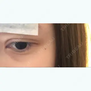 2日目の経過画像（1枚目）
