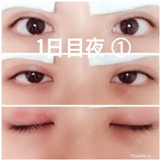 1日目の経過画像（1枚目）