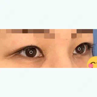 78日目の経過画像（3枚目）