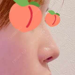 8日目の経過画像（1枚目）