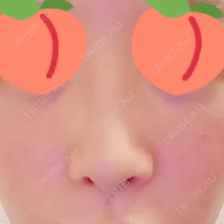 8日目の経過画像（2枚目）