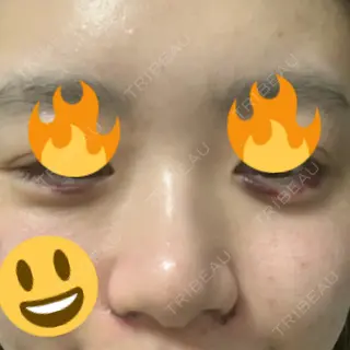 1日目の経過画像（2枚目）