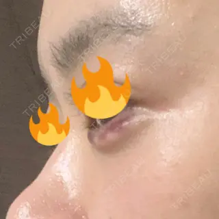 1日目の経過画像（3枚目）
