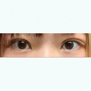 5日目の経過画像（1枚目）