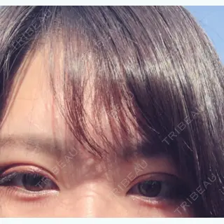 20日目の経過画像（2枚目）
