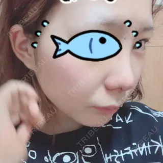 5日目の経過画像（3枚目）