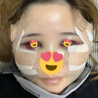 2日目の経過画像（1枚目）