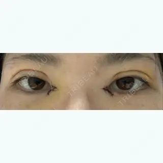 5日目の経過画像（1枚目）