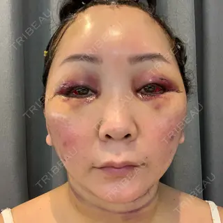 2日目の経過画像（1枚目）