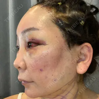 2日目の経過画像（3枚目）