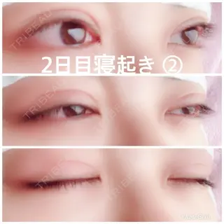 2日目の経過画像（2枚目）