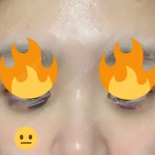 3日目の経過画像（1枚目）