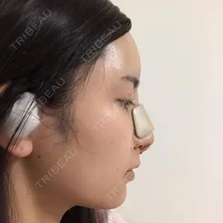 0日目の経過画像（2枚目）