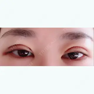 3日目の経過画像（1枚目）