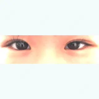 20日目の経過画像（1枚目）