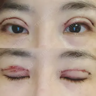 0日目の経過画像（1枚目）