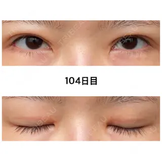 104日目の経過画像（1枚目）