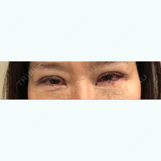 0日目の経過画像（1枚目）