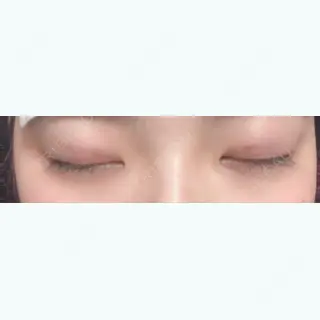 1日目の経過画像（2枚目）