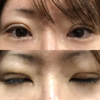 13日目の経過画像（1枚目）