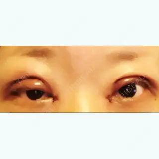 1日目の経過画像（1枚目）