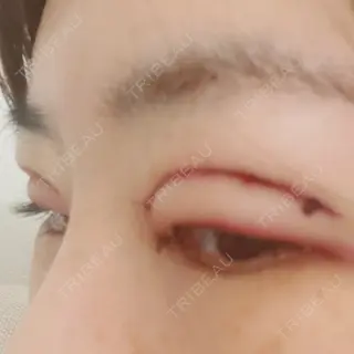 1日目の経過画像（2枚目）