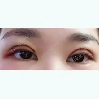 4日目の経過画像（1枚目）