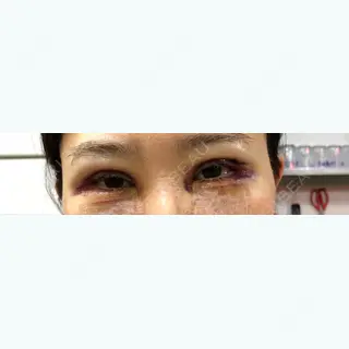 2日目の経過画像（1枚目）