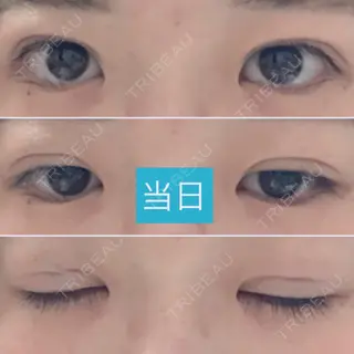 0日目の経過画像（1枚目）