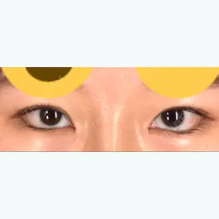 11日目の経過画像（1枚目）