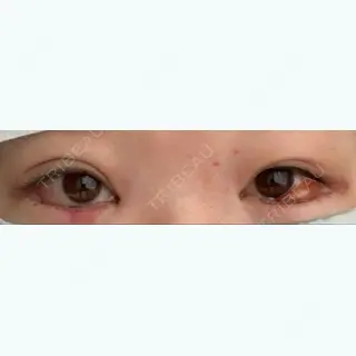 1日目の経過画像（1枚目）