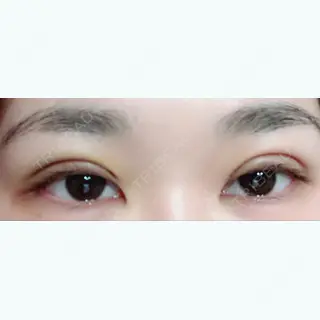 5日目の経過画像（1枚目）